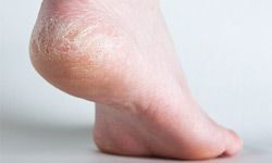You don't need pedicures to have healthy feet, but adding some moisture to dry, cracked heels would be a good start.