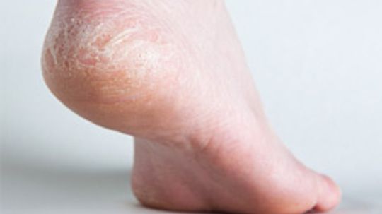 Top 5 Foot Moisturizing Tips for Men