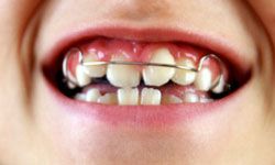 Even though retainers are sometimes worn to prep teeth for braces, they're most commonly worn after braces to keep teeth straight and in place.