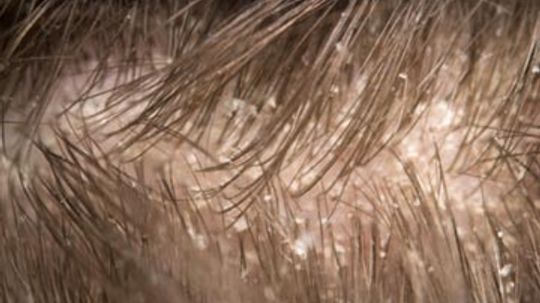 Quick Tips: Dandruff Remedies