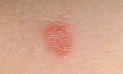 Tinea corporis, or ring worm, is a skin fungus that can form on the body's trunk, extremities and under the arm.