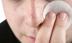 Support from NASA engineering helped create a new tool to fight acne.