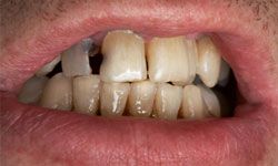 5 Ways to Care for Your Teeth After Your Enamel Has Worn | HowStuffWorks