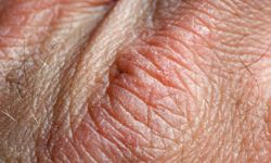 Dry skin is another bothersome problem that often comes with age.
