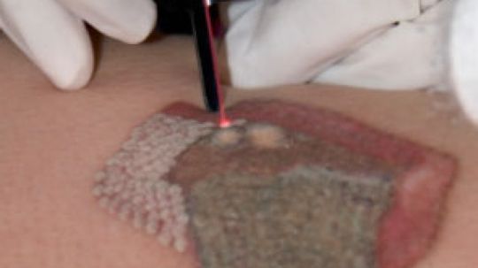 How Tattoo Removal Works