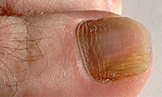 脚趾甲真菌”class=