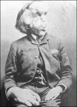 The last known picture of Joseph Merrick (circa 1890).